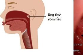 Triệu chứng ung thư vòm hầu