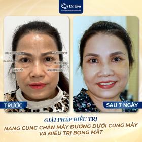 Dr. Eye - Địa chỉ điều trị bọng mắt tại TPHCM dành cho phụ nữ  第2张