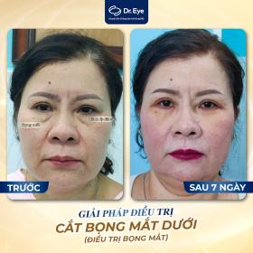 Dr. Eye - Địa chỉ điều trị bọng mắt tại TPHCM dành cho phụ nữ  第3张